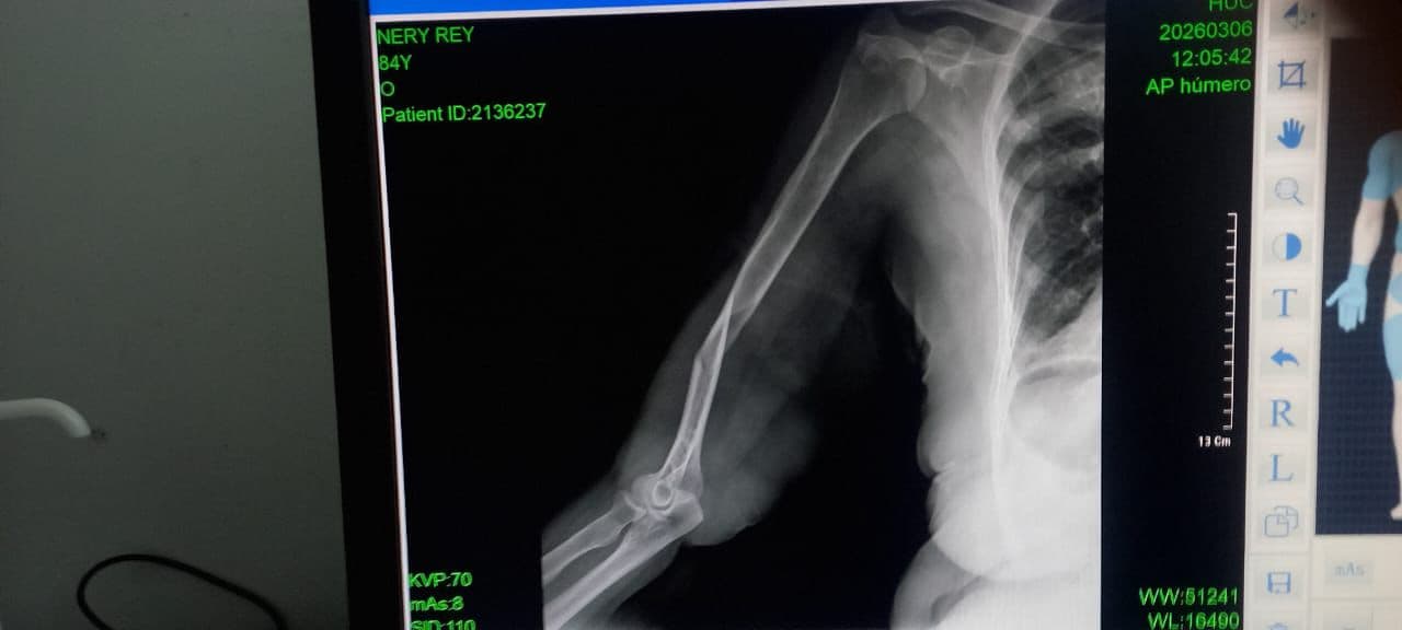 Radiografía de la fractura de húmero de Neris
